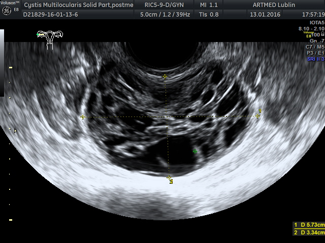 cysta wielokomorowa jajnika