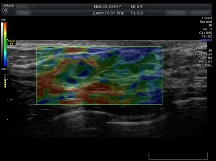 przyklad badania z wykorzystaniem elastografii guzka piersi