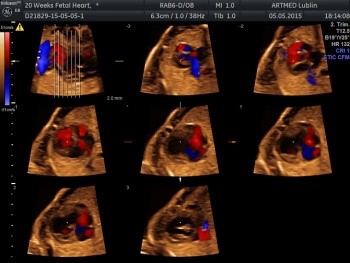Badanie 4D serca płodu