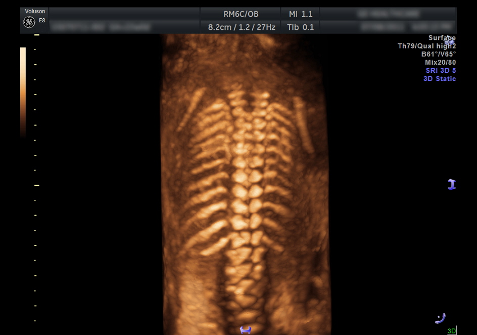 trojwymiarowy obraz kregoslupa plodu w 20tym tygodniu ciazy